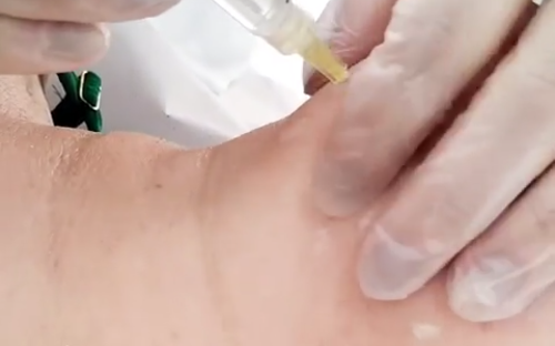 Lipo de papada