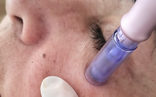 Microbotox