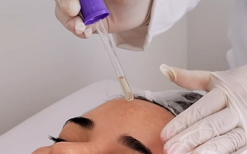 Peeling Químico