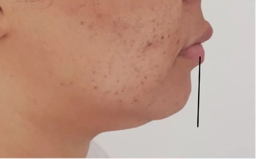 Preenchimento de Mento, Malar ou Mandibula