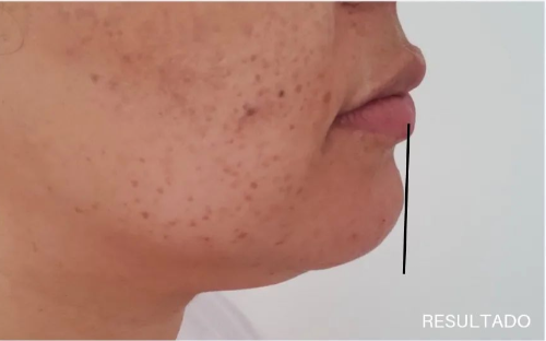 Preenchimento de Mento, Malar ou Mandibula