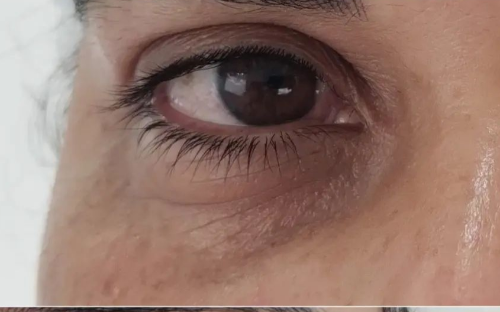 Preenchimento de Olheiras