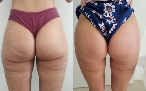 Subcisão para celulites e Cicatrizes de acne