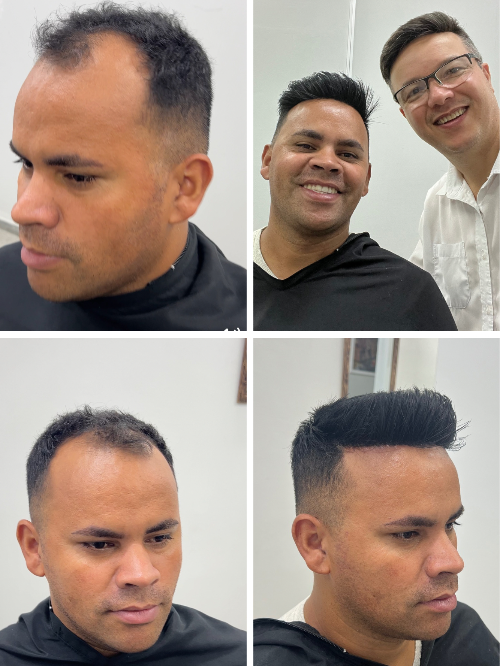 Próteses capilar masculina