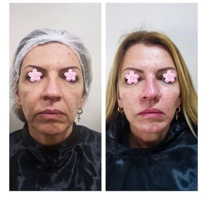 Preenchimento FACIAL