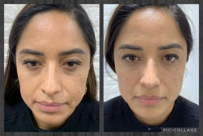 Preenchimento FACIAL