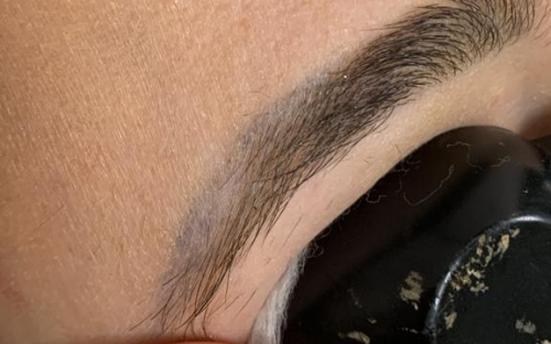 REMOÇÃO A LASER