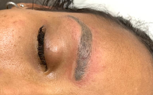 REMOÇÃO A LASER