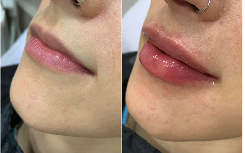 Preenchimento Labial