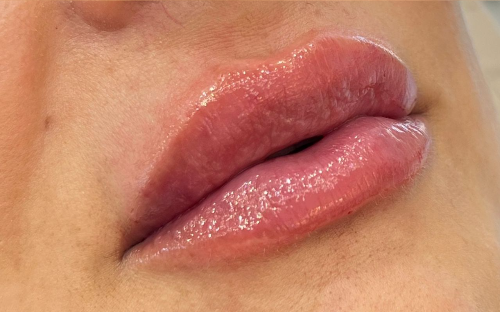 Preenchimento Labial