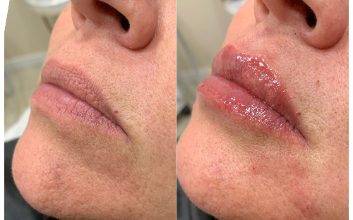 Preenchimento Labial