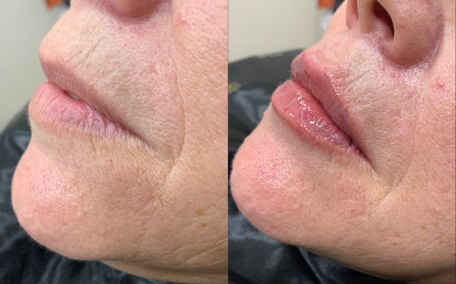 Preenchimento Labial